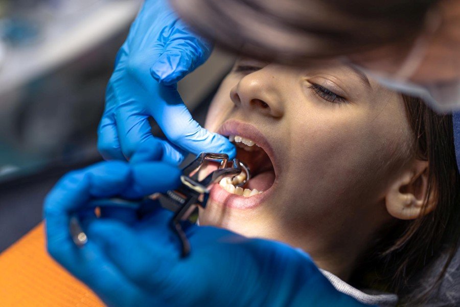 Gentle and Safe Tooth Extraction